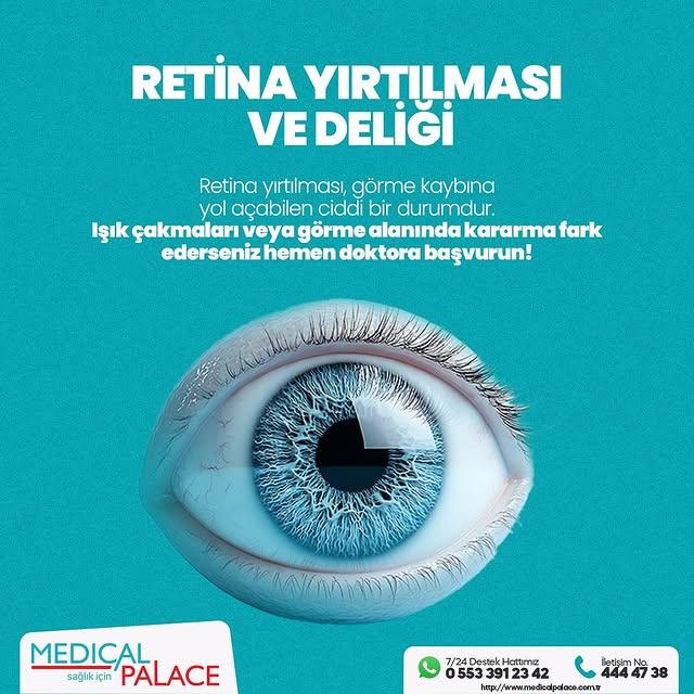 Retina Dekolmanı Nedir?