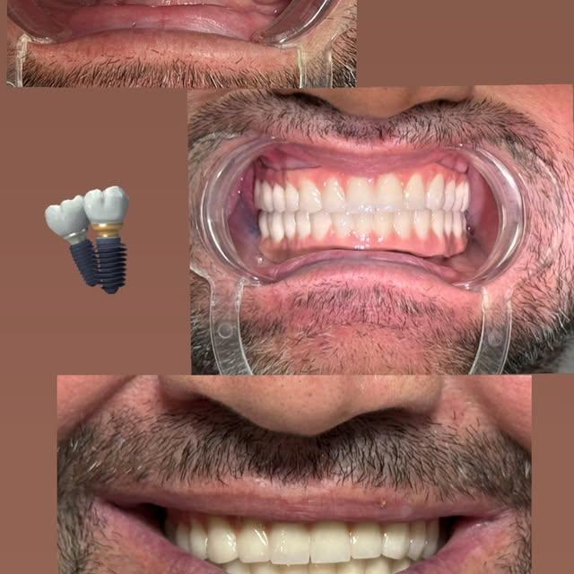 Niğde'de Dental Implant Tedavisiyle Yeni Gülümseme Umudu